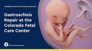 Gastroschisis Repair at the Colorado Fetal Care Center [upl. by Lemaj]