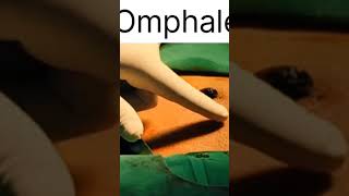 Umbilical granulomaAbscess viralvideo hospital viralshort viralvideos tranding [upl. by Ulphi]