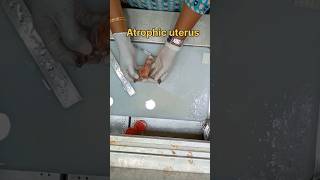 Atrophic uterus specimen அட்ராபிக் கருப்பை  biopsy satisfying pathology histopathology [upl. by Hayidan]