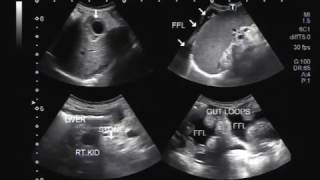 Ultrasound Video showing findings of a typical patient suffering from Hepatic Parenchymal disease [upl. by Jordanson]