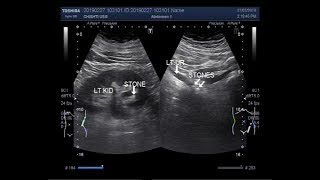 Ultrasound Video showing two stones in ureter [upl. by Westfahl]