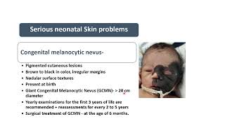 Congenital Melanocytic Nevus  Spot Diagnosis 27  Pediatrics [upl. by Trisha904]