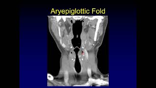 Larynx Anatomy for Staging Squamous Cell Carcinoma Part 1 [upl. by Hbahsur130]