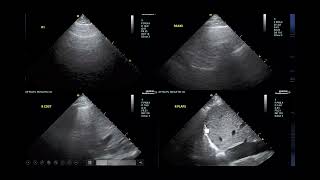 Normotensive Cardiogenic Shock [upl. by Gould785]