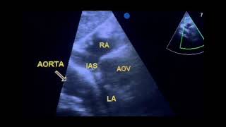 Thoracic aorta mimicking a cyst to drahmadmirdamadisiLWTYGsHPjR19laMW [upl. by Comyns350]