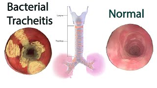 Bacterial Tracheitis  Symptoms causes and treatment [upl. by Adian931]