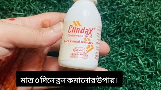 ৩ দিনে মুখের সব ব্রন দূর করার উপায় clindax lotion er upokarita  bron dur korar upay [upl. by Jorge]