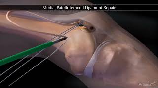 Reparation ligament fémoropatellaire MPFL  Chirurgie Instabilité de rotule  Dr Tournemine [upl. by Hyacinthia]