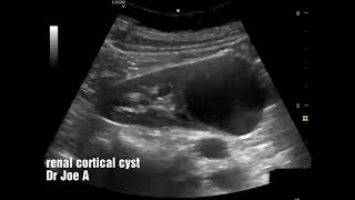 Renal cortical cyst left kidney ultrasound video [upl. by Scuram]