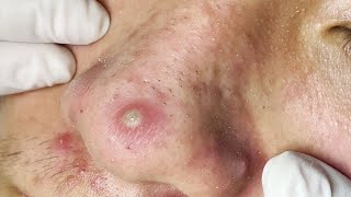 Big Cystic Acne Blackheads Extraction Blackheads amp Milia Whiteheads Removal Pimple Popping  2740 [upl. by Darya715]