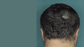 Drug Restores Hair Growth in Patients with Alopecia Areata [upl. by Nitin]