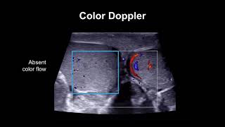 Diagnosing testicular torsion [upl. by Havener]