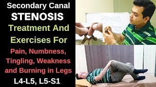 Spinal stenosis L4L5L5S1 Foraminal stenosis Spinal Stenosis treatment spine stenosis exercises [upl. by Nilyac]