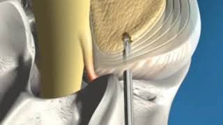 SpineJet Contained Disc Herniation Surgical Animation [upl. by Esereht]