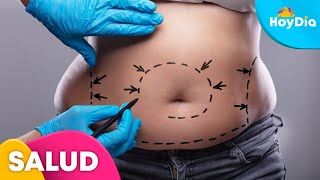 Abdominoplastia y liposucción 360 Procedimientos que cambian vidas  Hoy Día  Telemundo [upl. by Rochus]