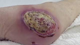 Wound Care Part 3 Types of Wounds [upl. by Mok202]