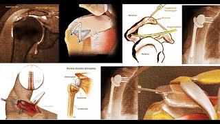 Management of Massive Rotator Cuff Tears A Long Didactic Video [upl. by Dnilazor]