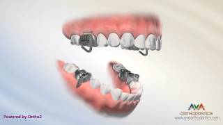 Orthodontic Treatment for Overjet Overbite  MARA Appliance [upl. by Icat38]