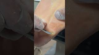 Tough Combination Calluses and Athletes Foot [upl. by Nirat]