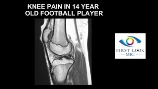 Knee pain in 14 year old football player [upl. by Ellehcrad]