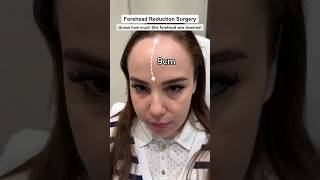 FOREHEAD REDUCTION 📏 Dr Ahmet Dilber foreheadreduction foreheadlowering plasticsurgery [upl. by Ynatsyd350]