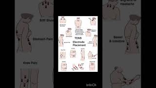 Electrotherapy physiotherapyequipment muscleexercises bestphysiotherapy bestphysiotherapy [upl. by Oirelav]