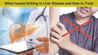 What Causes Itching in Liver Disease and How to Treat  Nuse Healthy [upl. by Celestine882]