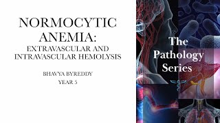 Normocytic anemia  With predominant intravascular and extravascular hemolysis [upl. by Inotna413]