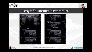 Ecografía del nódulo tiroideo 24mn [upl. by Neelrak]