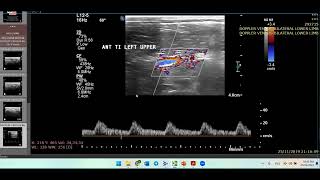 Thromboangitis ObliteransHow to ThinkDoppler Ultrasound Case [upl. by Ybrek]