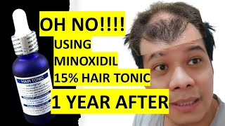 MINOXIDIL 15 Hair Tonic Results after 1 year  2021 Surprising OUTCOME [upl. by Ayak]