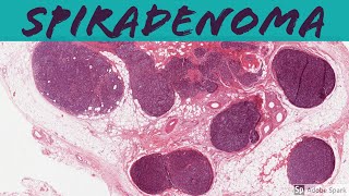 Spiradenoma 5Minute Pathology Pearls [upl. by Adav]