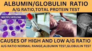 ALBUMIN TO GLOBULIN RATIOAG RATIO TESTHIGH AND LOW AG RATIOAG RATIO INLIVER AND KIDNEY PROBLEM [upl. by Aizatsana426]