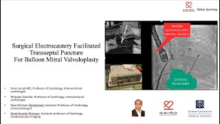 Surgical Electrocautery Facilitated Transseptal Percutaneous mitral balloon commissurotomy PMBC [upl. by Sofia]