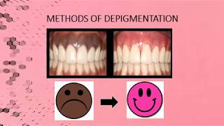 Gingival Melanin Depigmentation  Case Report [upl. by Tloc]