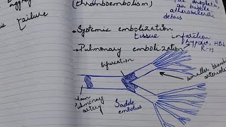 Embolism  Thromboembolism  pulmonary embolism  general pathology  Robbins pathology [upl. by Akinet]