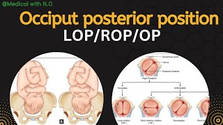 occiput posterior right occipitoposterior  left occipitoposterior LOP ROP MEDICALwithNO [upl. by Atilrahc756]