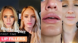 My first time getting LIP FILLERS before AND after  1 syringe Juvederm Ultra [upl. by Meg]