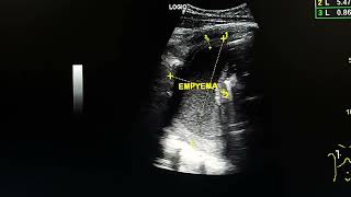 Chest ultrasound shows empyema in a female Hx renal failure [upl. by Anelehs]