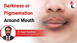 Darkness or Pigmentation Around Mouth  Darkening Around Mouth Causes  Treatment  Dermatologist [upl. by Ennagem]