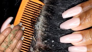 Scalp scratching and picking  Satisfying Dandruff Removal ASMR  Psoriasis [upl. by Spaulding628]