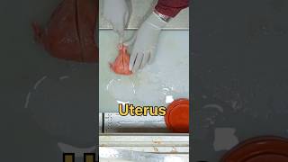 uterus with bilateral adnexa specimen [upl. by Atekihs514]