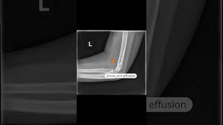 Distal humerus fracture xray virlshorts [upl. by Htebarual]