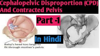 Cephalopelvic Disproportion In HindiCPDIIContracted Pelvis IICausesIINightingale Nursing Academy [upl. by Raina]