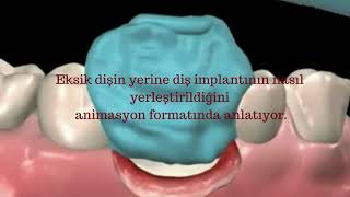 İmplant Diş Takılması  Bu Video Adım Adım Dental İmplant Cerrahisi  Dr Ömer Pirinç 0216 577 60 08 [upl. by Elehcor]