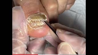 Ingrown toenail removal very satisfying video [upl. by Milman]