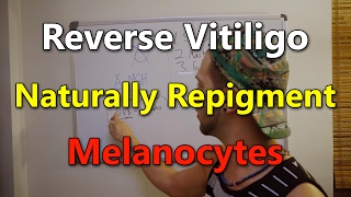 VITILIGO Increase Natural Pigmentation  Reverse Vitiligo amp Increase alphaMSH [upl. by Aicerg934]