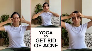 Face Yoga To Get Rid Of Acne  6 Exercises To Get Clear Skin  Yoga With Mansi  Fit Tak [upl. by Charleen791]