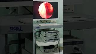 ENDOSCOPIC ETHMOID SINUS EXPLORATION maxillofacialsurgeon face surgeryrecovery youtubeshorts [upl. by Smiga]