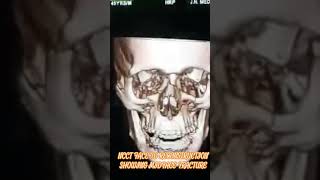 NCCT Face 3D Reconstruction showing Midface fracture [upl. by Aihsit822]